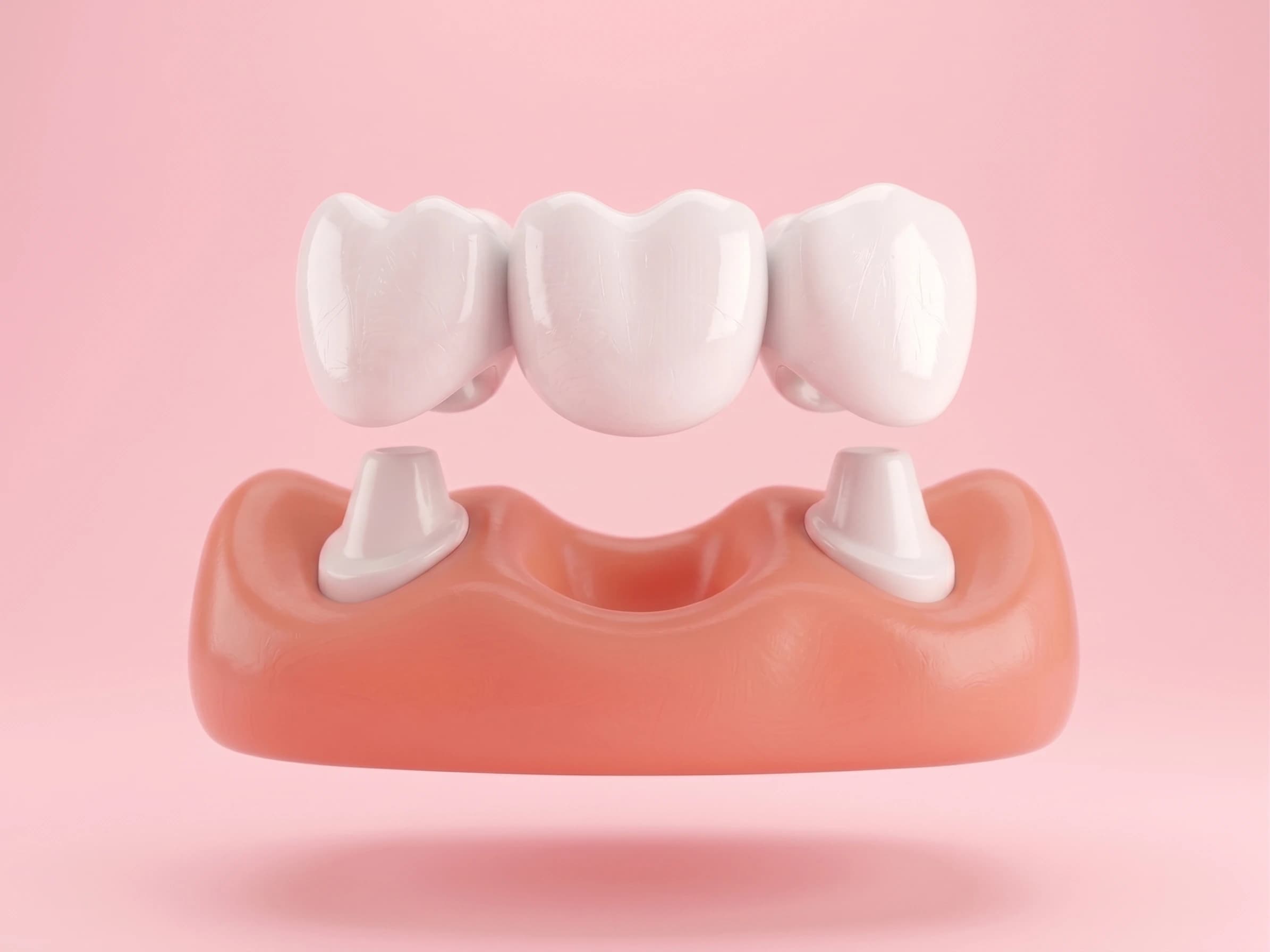 Servicio de prótesis dentales